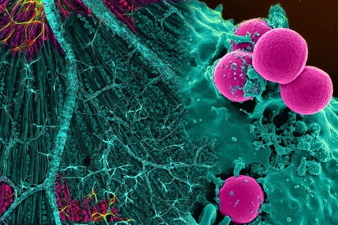 Cèl·lules cancerígenes al microscopi